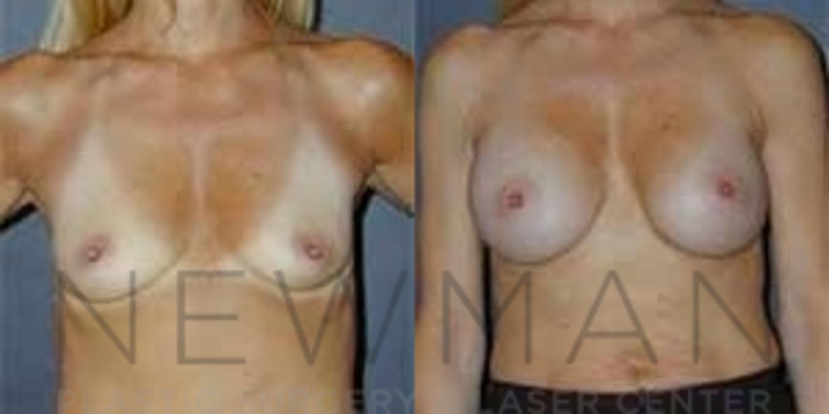 Before & After Breast Augmentation Case 96 Front View in Westchester County & Long Island, NY