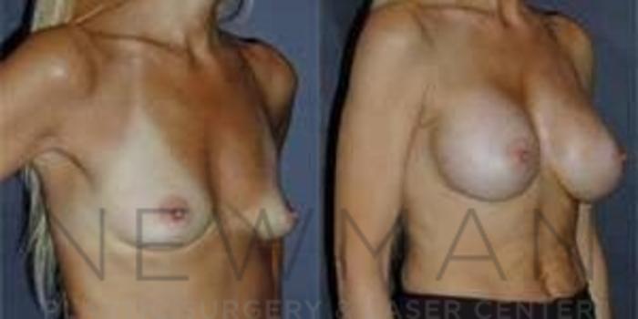 Before & After Breast Augmentation Case 96 Right Oblique View in Westchester County & Long Island, NY