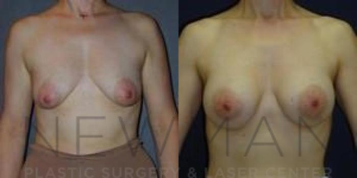 Before & After Breast Augmentation Case 97 Front View in Westchester County & Long Island, NY