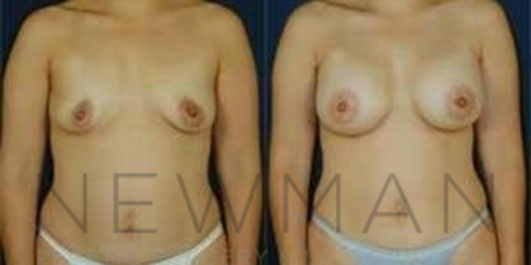 Before & After Breast Augmentation Case 98 Front View in Westchester County & Long Island, NY