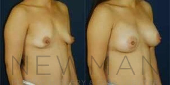 Before & After Breast Augmentation Case 98 Right Oblique View in Westchester County & Long Island, NY