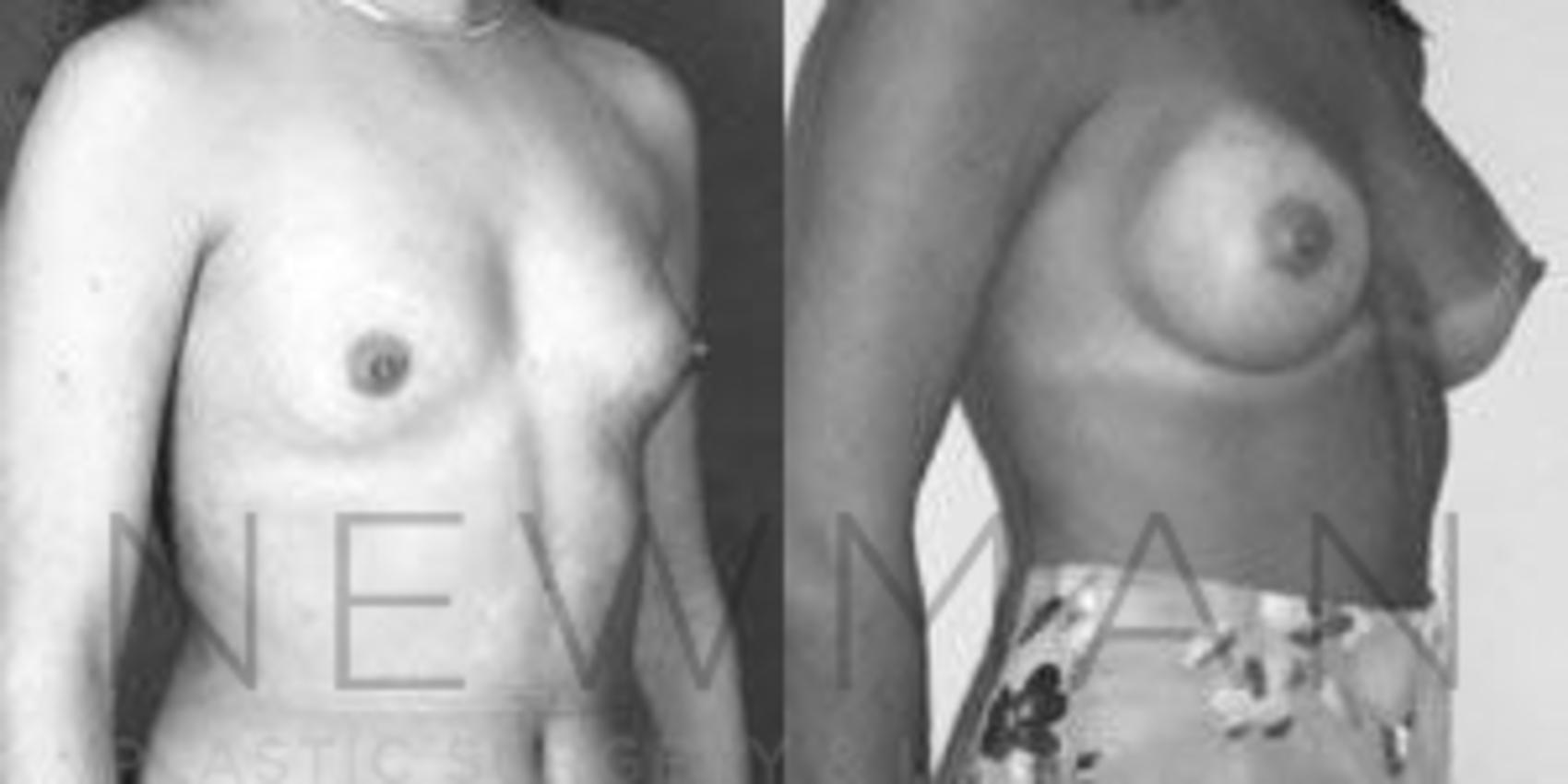 Before & After Breast Augmentation Case 99 Right Oblique View in Westchester County & Long Island, NY