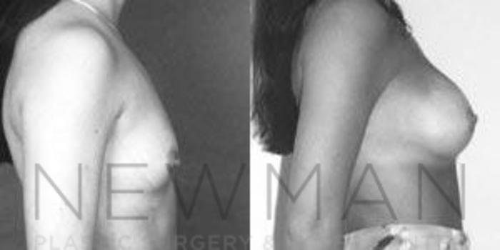 Before & After Breast Augmentation Case 99 Right Side View in Westchester County & Long Island, NY