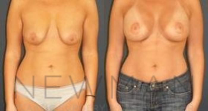 Before & After Breast Lift Case 60 Front View in Yonkers, NY