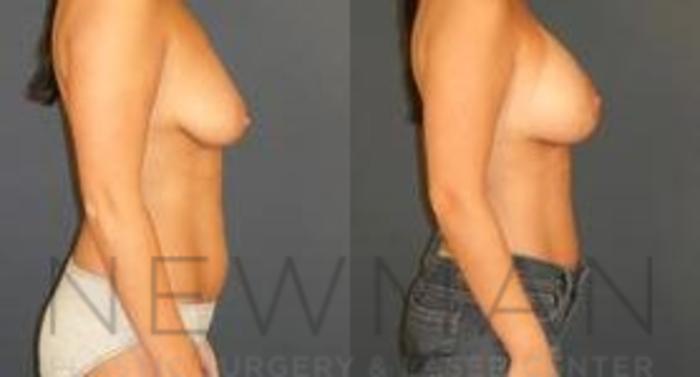 Before & After Breast Lift Case 60 Right Side View in Westchester County & Long Island, NY