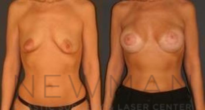 Before & After Breast Lift Case 61 Front View in Yonkers, NY