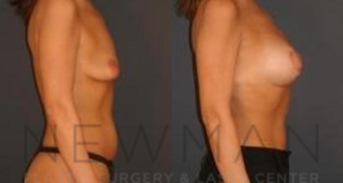Before & After Breast Lift Case 61 Right Side View in Westchester County & Long Island, NY