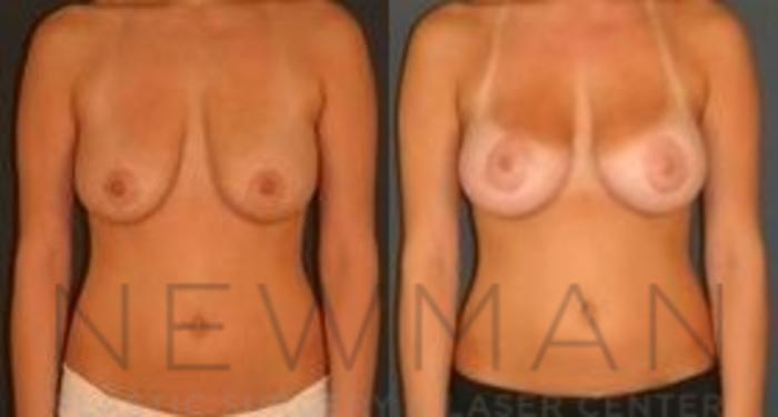 Before & After Breast Lift Case 62 Front View in Westchester County & Long Island, NY