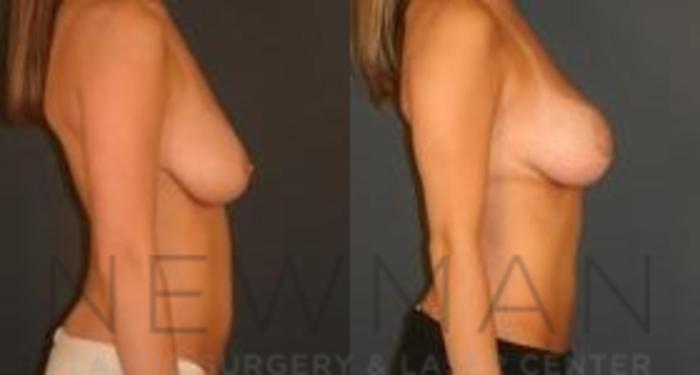 Before & After Breast Lift Case 62 Right Side View in Westchester County & Long Island, NY