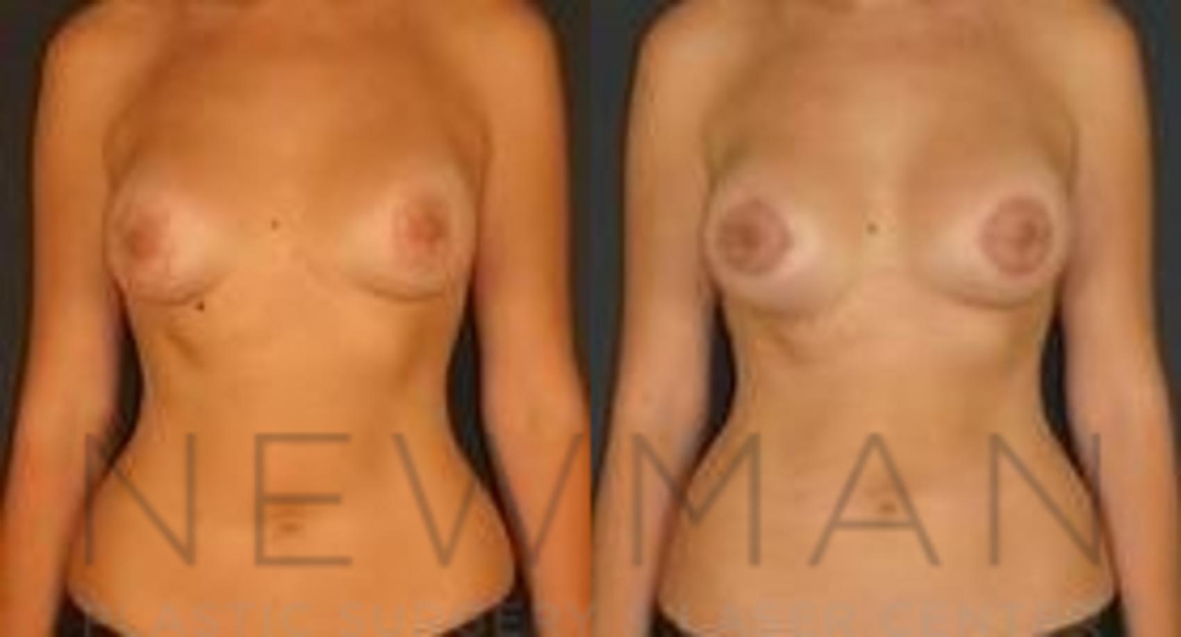 Before & After Breast Lift Case 63 Front View in Westchester County & Long Island, NY