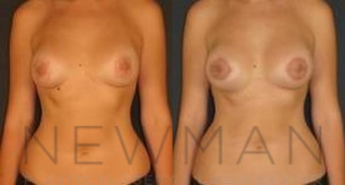 Before & After Breast Lift Case 63 Front View in Yonkers, NY