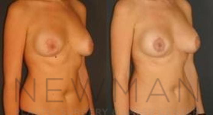 Before & After Breast Lift Case 63 Right Oblique View in Westchester County & Long Island, NY