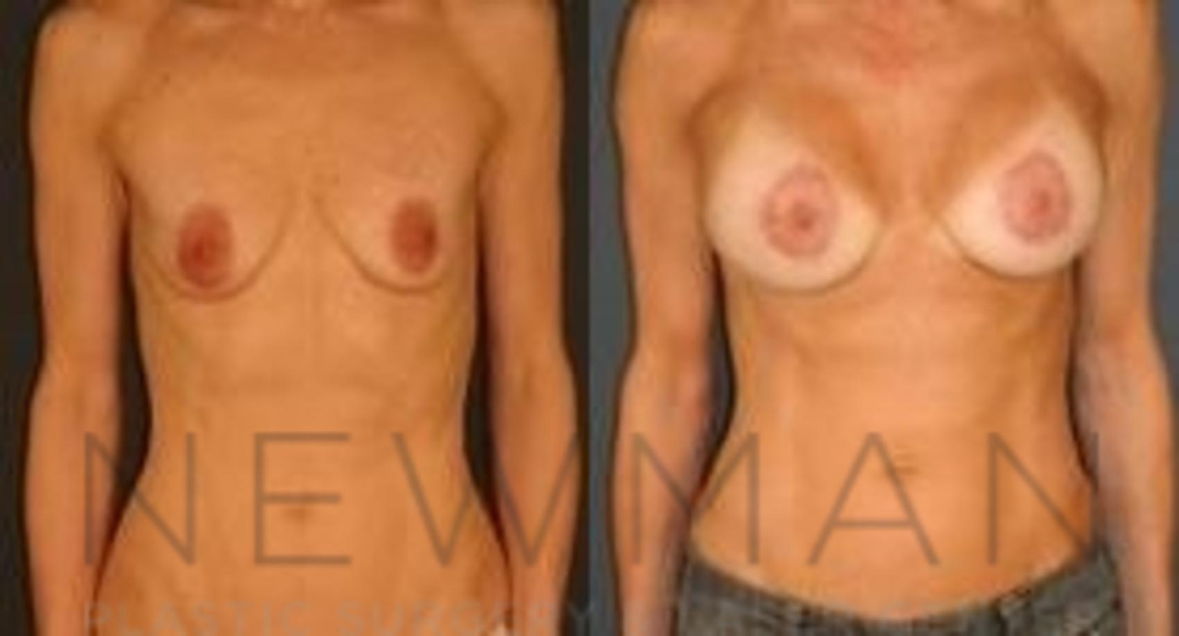 Before & After Breast Lift Case 64 Front View in Westchester County & Long Island, NY