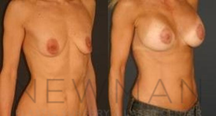 Before & After Breast Lift Case 64 Right Oblique View in Westchester County & Long Island, NY