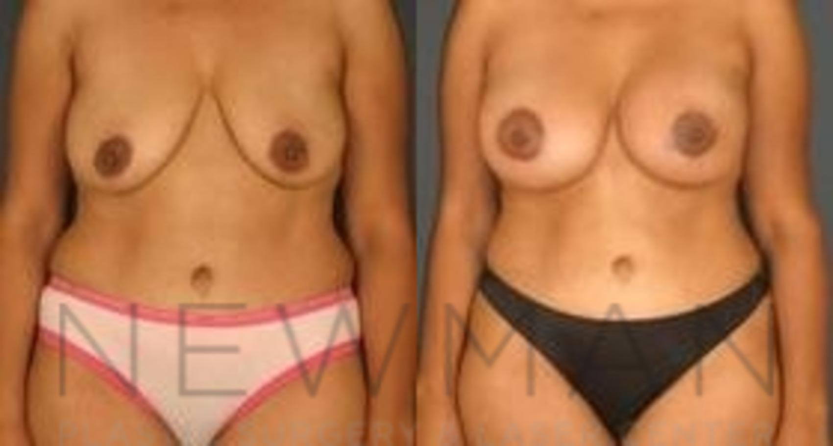 Before & After Breast Lift Case 65 Front View in Westchester County & Long Island, NY