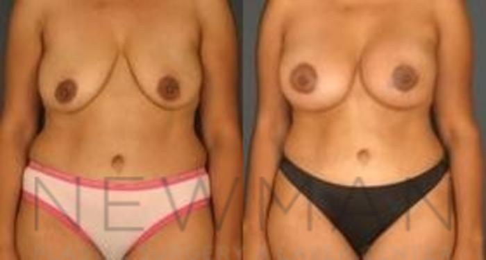 Before & After Breast Lift Case 65 Front View in Yonkers, NY