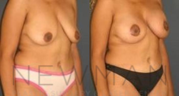 Before & After Breast Lift Case 65 Right Oblique View in Westchester County & Long Island, NY