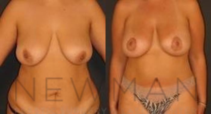 Before & After Breast Lift Case 66 Front View in Yonkers, NY
