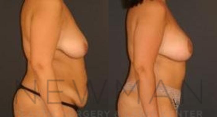 Before & After Breast Lift Case 66 Right Side View in Westchester County & Long Island, NY
