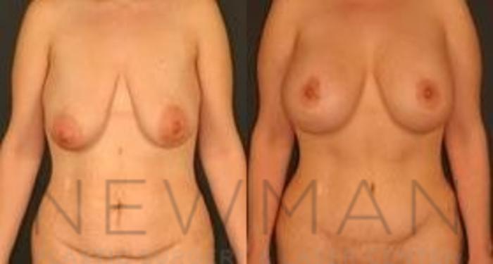 Before & After Breast Lift Case 67 Front View in Westchester County & Long Island, NY
