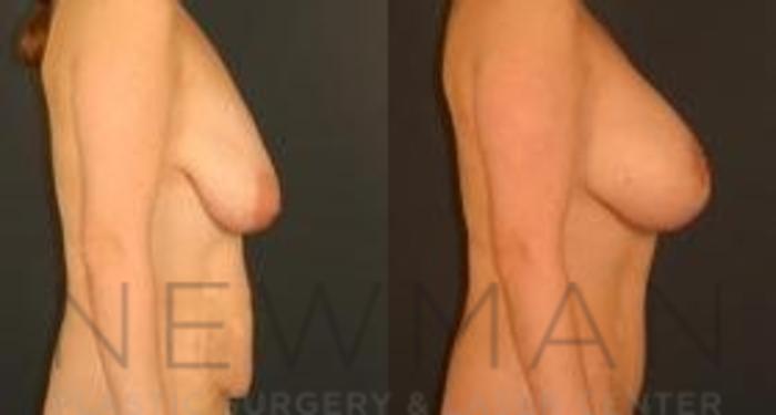Before & After Breast Lift Case 67 Right Side View in Westchester County & Long Island, NY