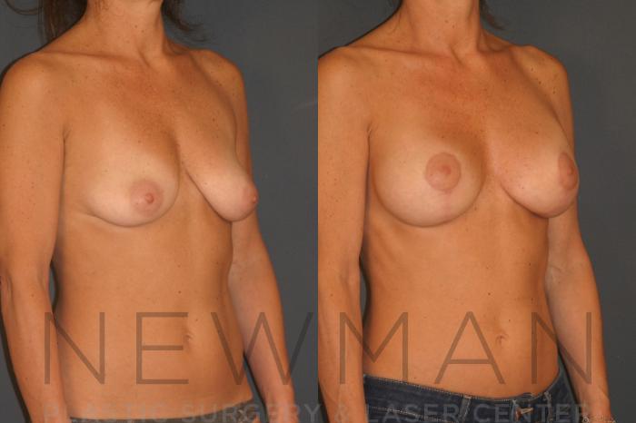 Before & After Breast Asymmetry Case 123 Right Oblique View in Westchester County & Long Island, NY