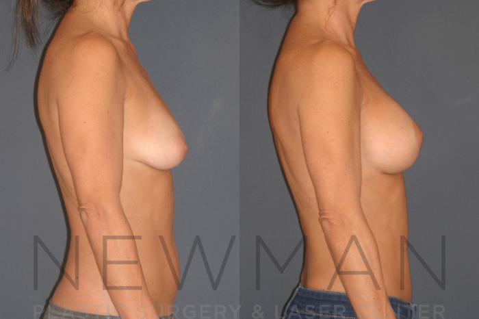 Before & After Breast Asymmetry Case 123 Right Side View in Westchester County & Long Island, NY