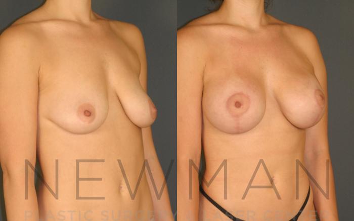 Before & After Breast Lift Case 124 Right Oblique View in Westchester County & Long Island, NY