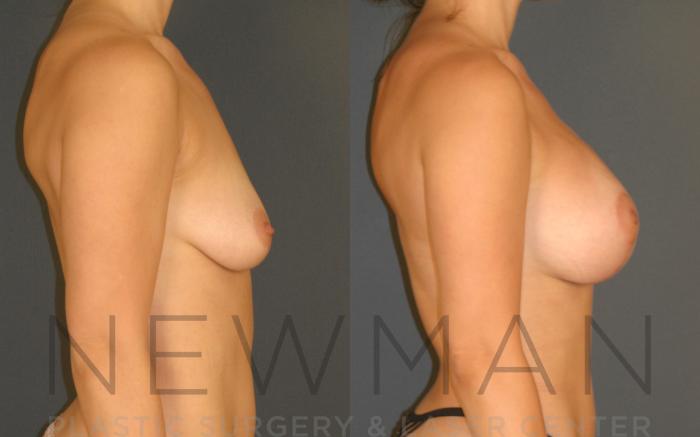 Before & After Breast Augmentation Case 124 Right Side View in Westchester County & Long Island, NY