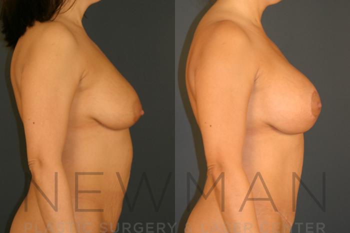 Before & After Breast Lift Case 125 Right Side View in Westchester County & Long Island, NY