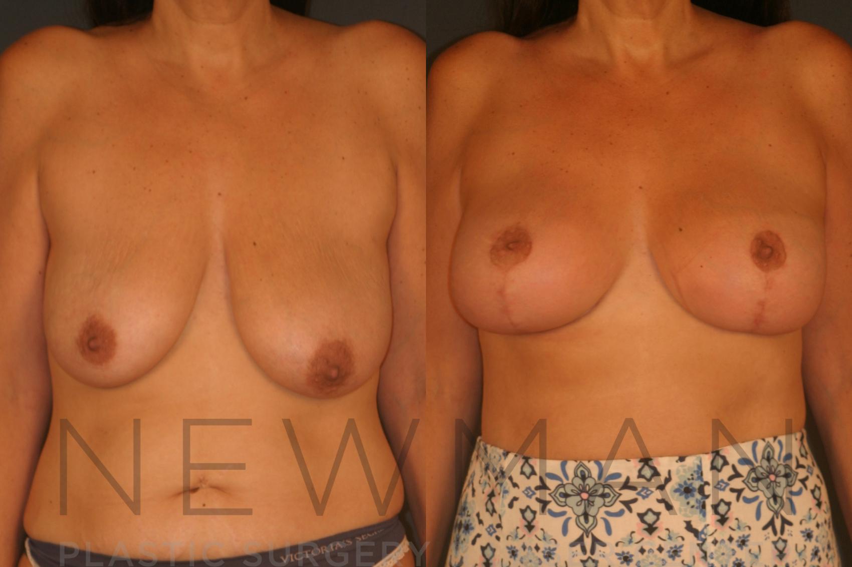 Before & After Breast Implants Case 126 Front View in Westchester County & Long Island, NY