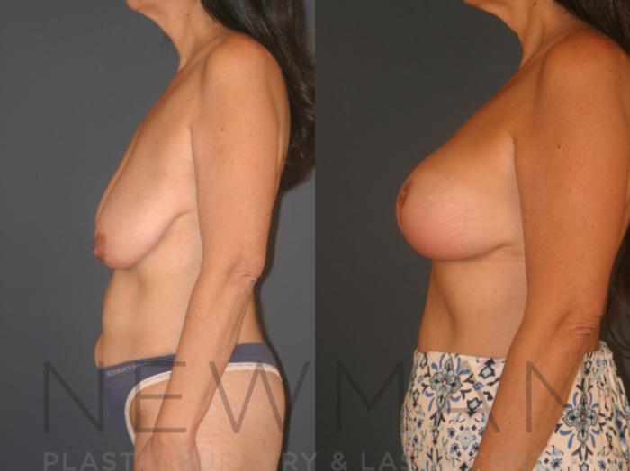 Before & After Breast Lift with Augmentation Case 126 Left Side View in Westchester County & Long Island, NY