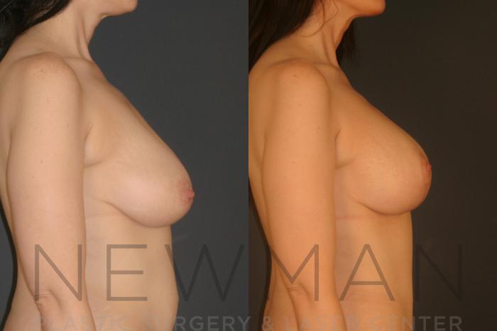 Before & After Breast Lift Case 127 Right Side View in Westchester County & Long Island, NY