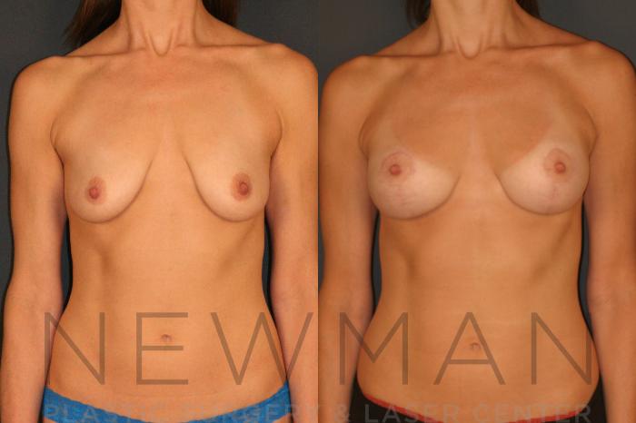 Before & After Breast Lift Case 128 Front View in Yonkers, NY