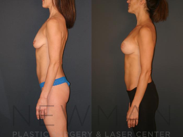 Before & After Breast Augmentation Case 128 Left Side View in Westchester County & Long Island, NY