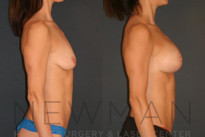 Before & After Breast Lift with Augmentation Case 128 Right Side View in Westchester County & Long Island, NY