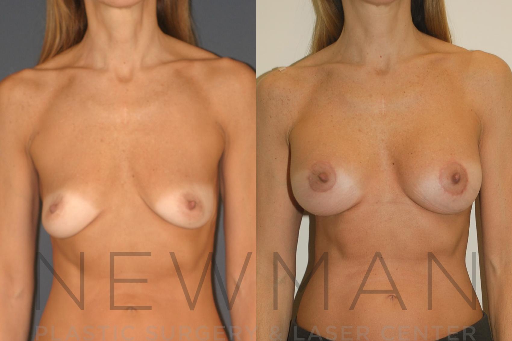 Before & After Breast Implants Case 129 Front View in Westchester County & Long Island, NY