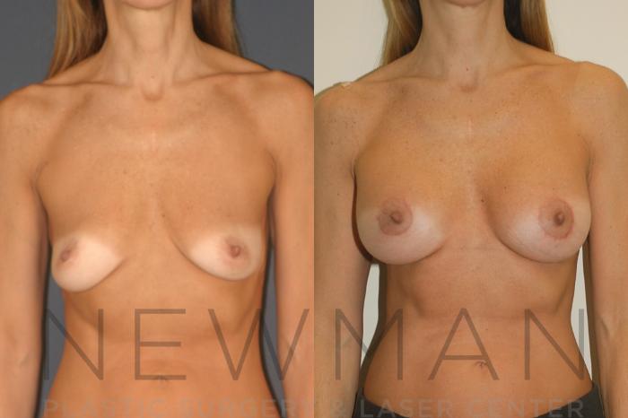 Before & After Breast Lift with Augmentation Case 129 Front View in Yonkers, NY