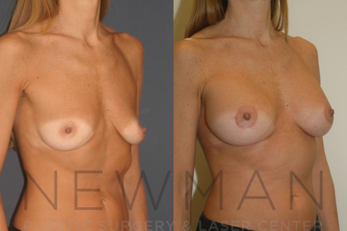 Before & After Breast Augmentation Case 129 Right Oblique View in Westchester County & Long Island, NY
