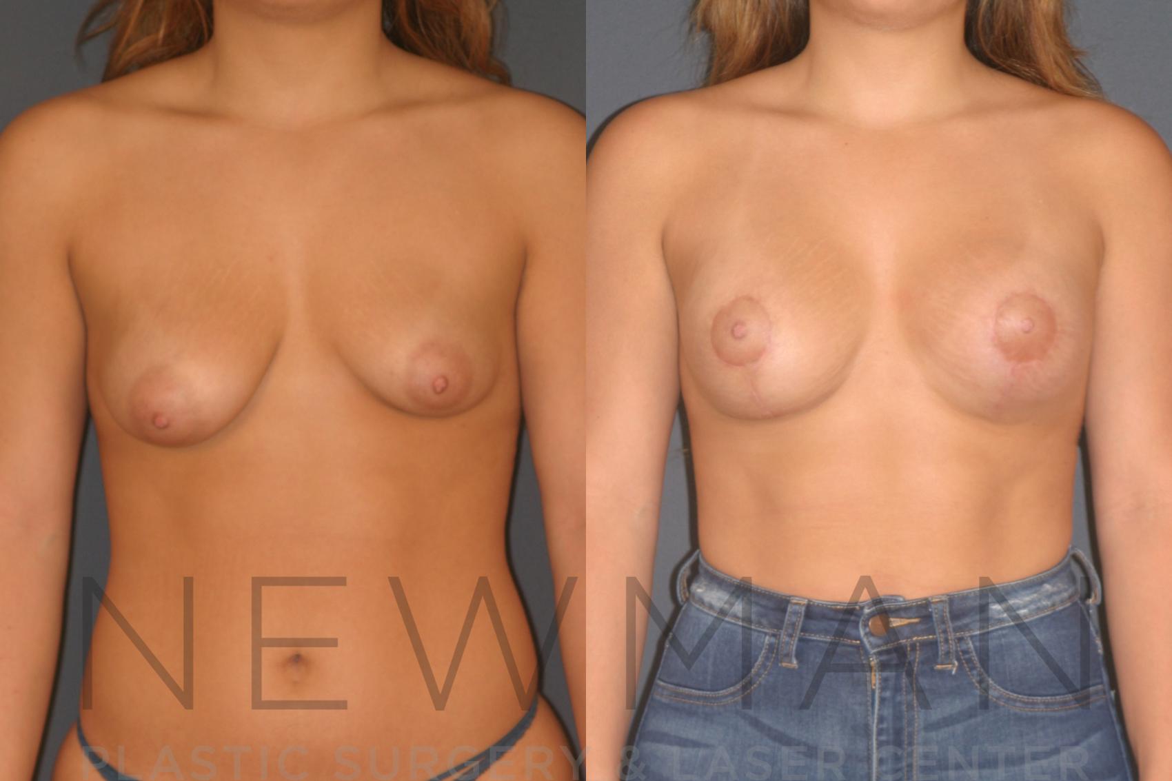 Before & After Breast Asymmetry Case 130 Front View in Westchester County & Long Island, NY