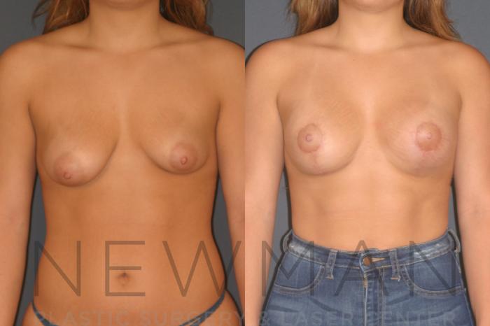 Before & After Breast Lift with Augmentation Case 130 Front View in Yonkers, NY