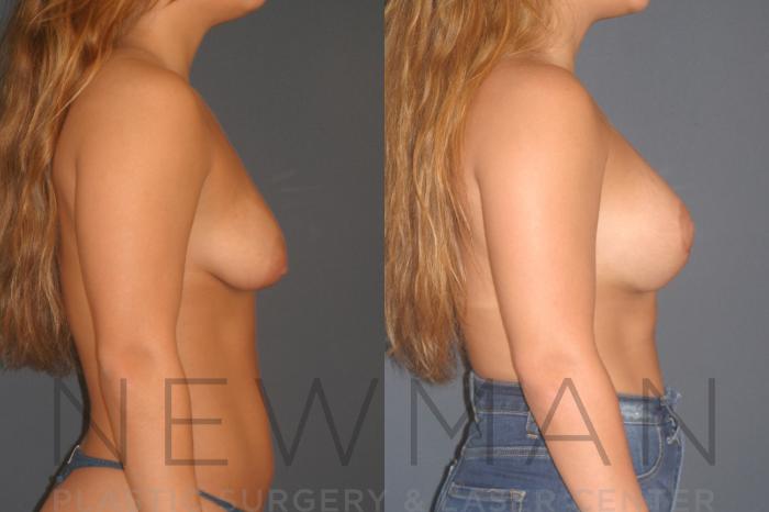 Before & After Breast Asymmetry Case 130 Right Side View in Westchester County & Long Island, NY