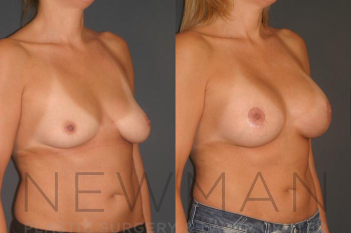 Before & After Breast Implants Case 131 Right Oblique View in Westchester County & Long Island, NY
