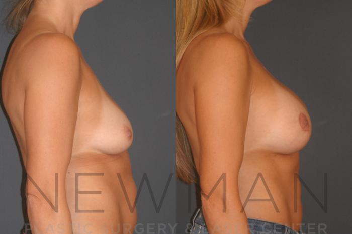 Before & After Breast Asymmetry Case 131 Right Side View in Westchester County & Long Island, NY