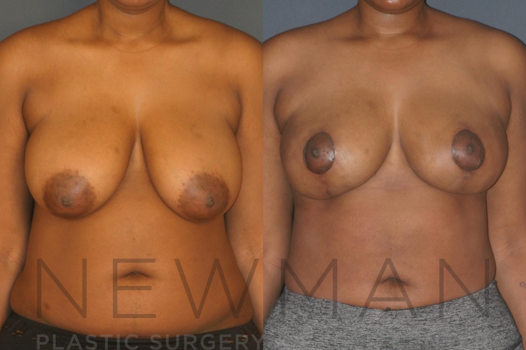 Before & After Breast Lift with Augmentation Case 132 Front View in Westchester County & Long Island, NY