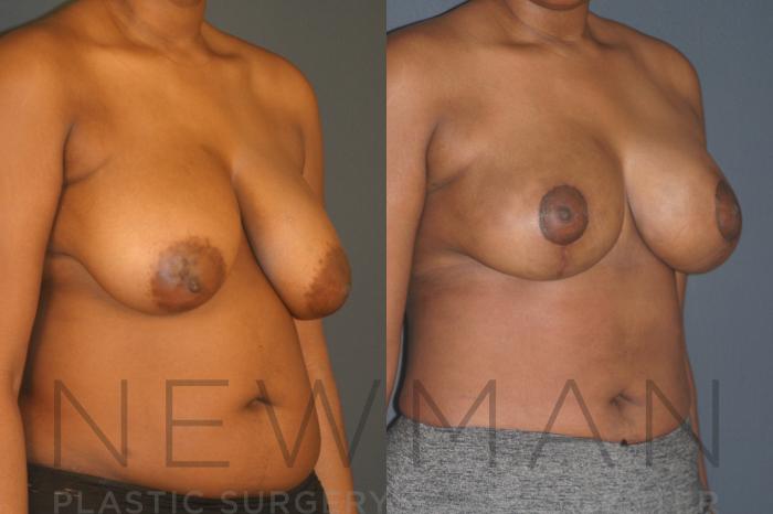 Before & After Breast Lift with Augmentation Case 132 Right Oblique View in Westchester County & Long Island, NY