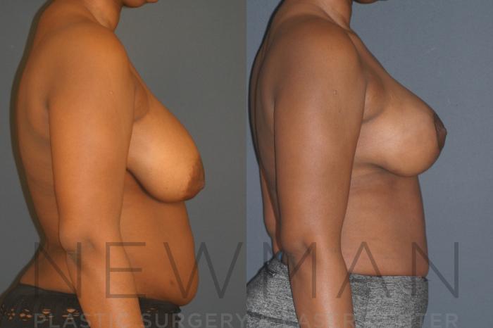 Before & After Breast Lift Case 132 Right Side View in Westchester County & Long Island, NY