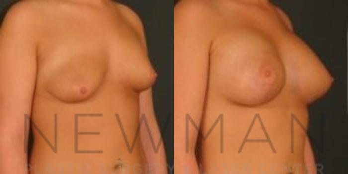 Before & After Breast Lift with Augmentation Case 49 Right Oblique View in Westchester County & Long Island, NY