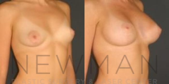 Before & After Breast Lift with Augmentation Case 50 Right Oblique View in Westchester County & Long Island, NY