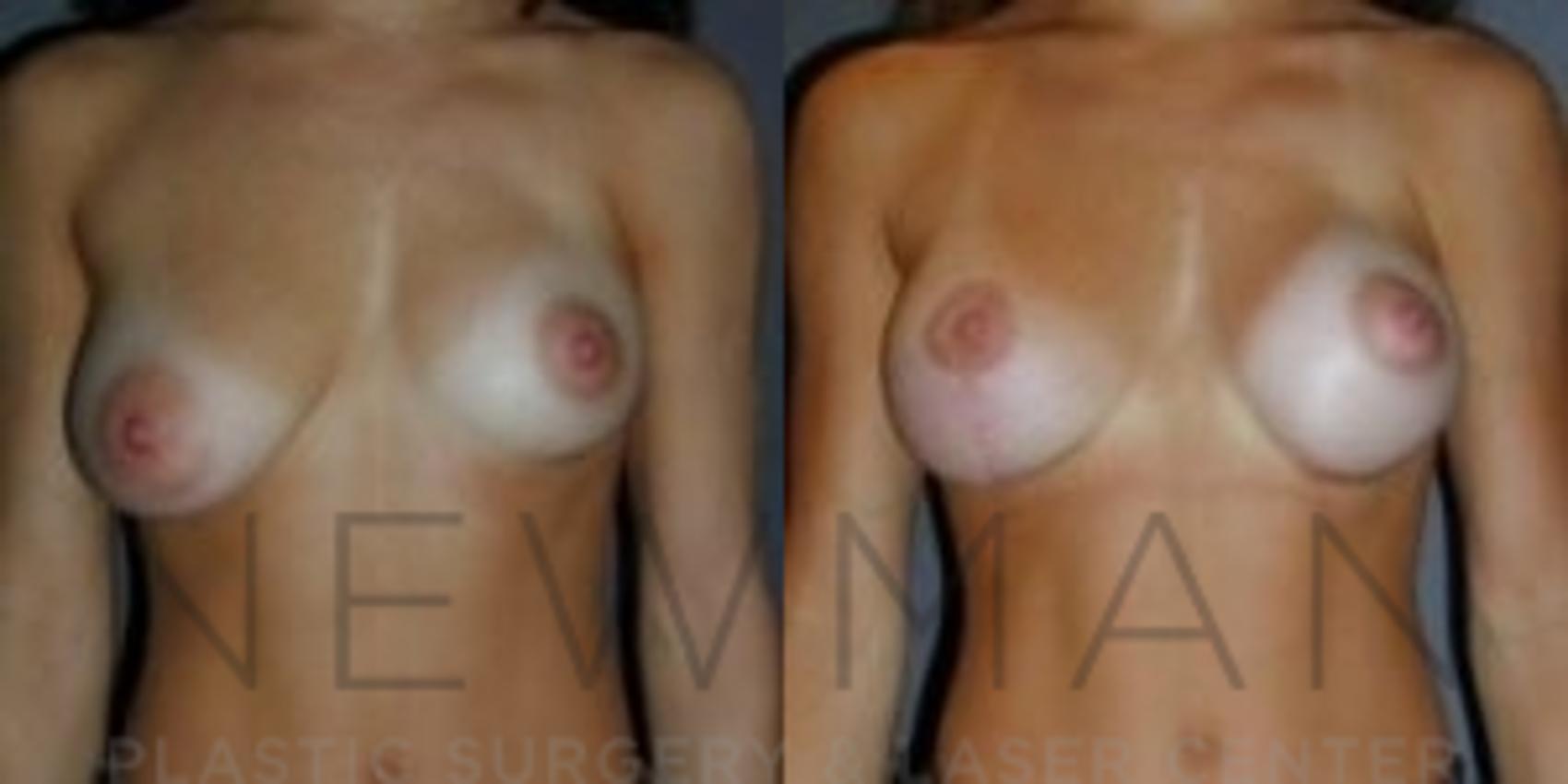 Before & After Breast Lift with Augmentation Case 53 Front View in Westchester County & Long Island, NY